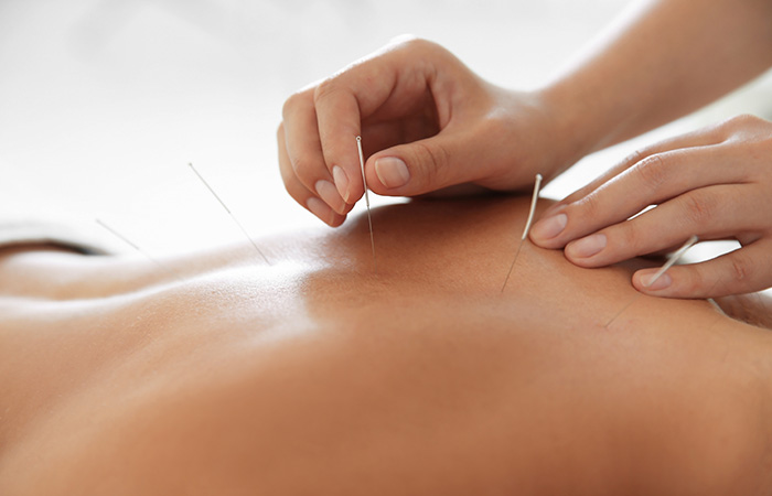 Medical Acupuncture by Dr Deniah Pachai Consultant
